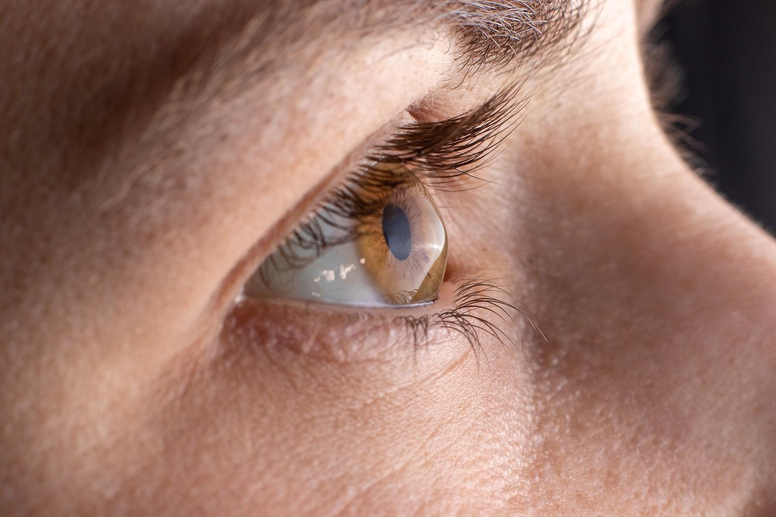 Keratoconus