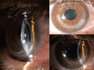 Tunnel Incisions