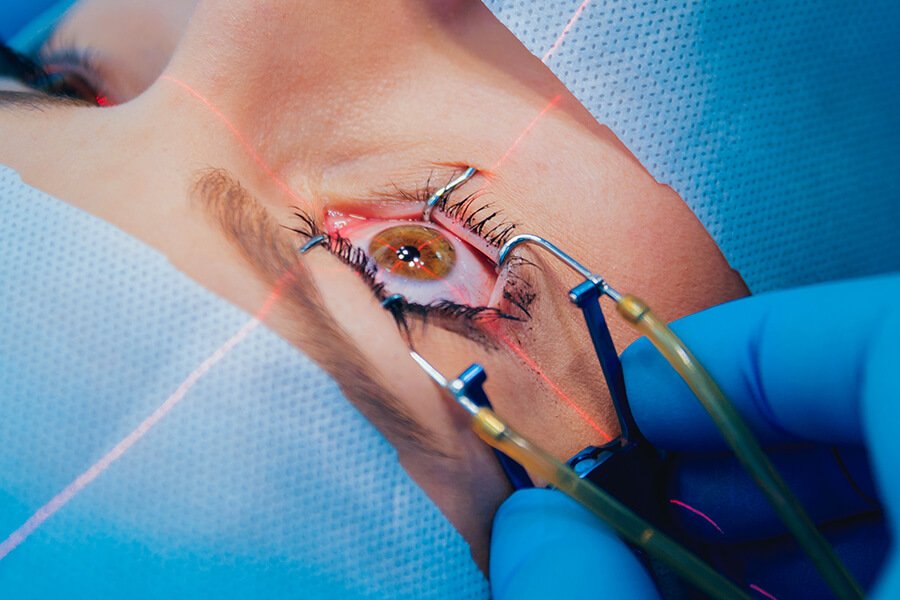 Femto LASIK