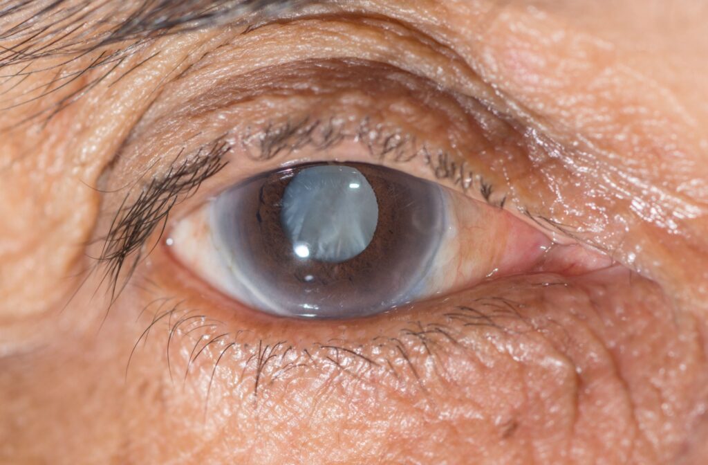 CATARACT: Types of Surgery