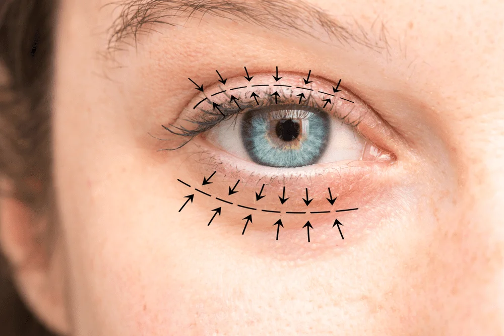 Oculoplastics